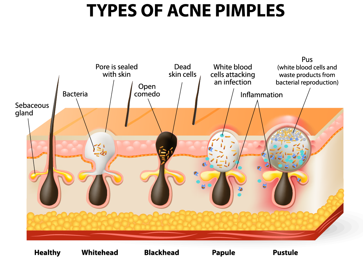 Diseases, Disorders, and Injuries of the Integumentary System Tutorial ...
