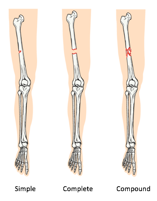 Split Joint Break Skeletal Health and Disorders Tutorial | Sophia Learning
